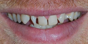 Before treatment by Jones and Zirker Dentists - Iowa City