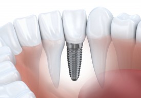 Jones & Zirker Family Dentistry Provide dental implants at their Iowa City office.