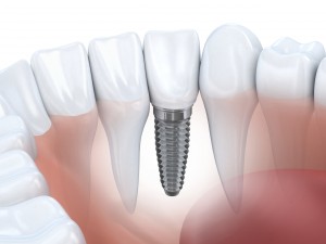 Jones & Zirker Family Dentistry Provide dental implants at their Iowa City office.