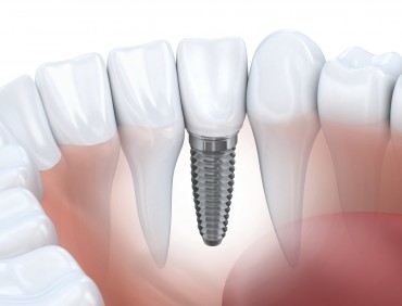 Jones & Zirker Family Dentistry Provide dental implants at their Iowa City office.